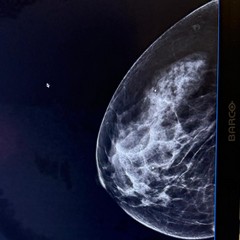 mammografia