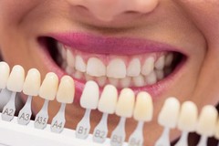 Faccette dentali: uno status symbol estetico sempre più popolare