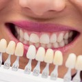 Faccette dentali: uno status symbol estetico sempre più popolare